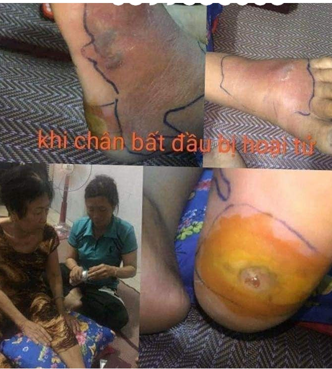Tiểu đường dùng diasure