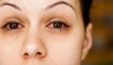 Đau mắt đỏ và những nguy cơ tiềm ẩn đối với sức khỏe