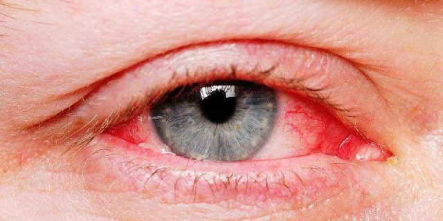 Đau mắt đỏ là căn bệnh vô cùng phổ biến