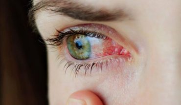 Viêm giác mạc có đáng sợ như lời đồn