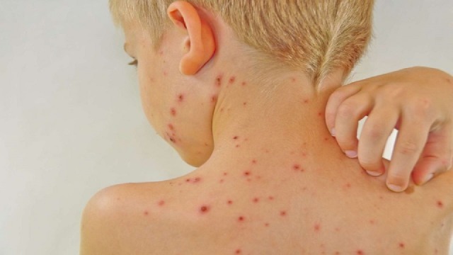 Sốt siêu vi là một căn bệnh cấp tính
