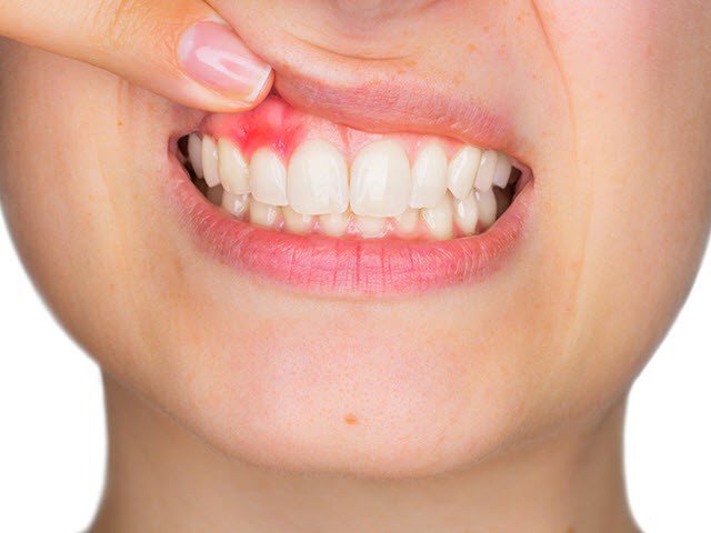 Viêm lợi gây nên nhiều cơn đau và viêm khó chịu