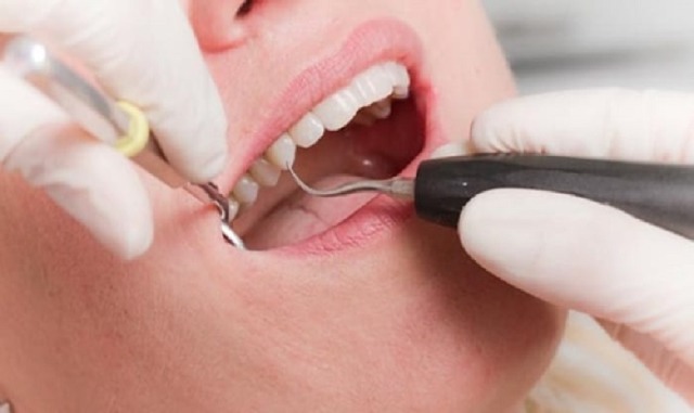 Một vài lưu ý trong việc chữa trị viêm lợi tại nhà