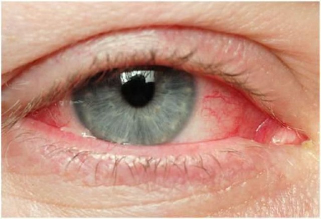 Bệnh liên quan đến hệ thống dây thần kinh mắt