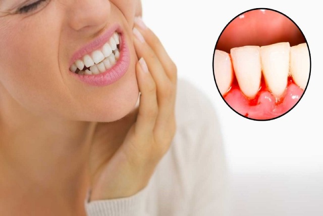 Bệnh viêm lợi được chia ra làm hai loại