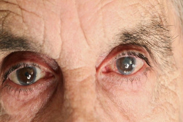 Bệnh do áp suất bên trong mắt tăng cao.