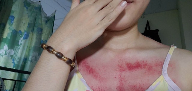 Liệu có nên cạo gió để điều trị không?