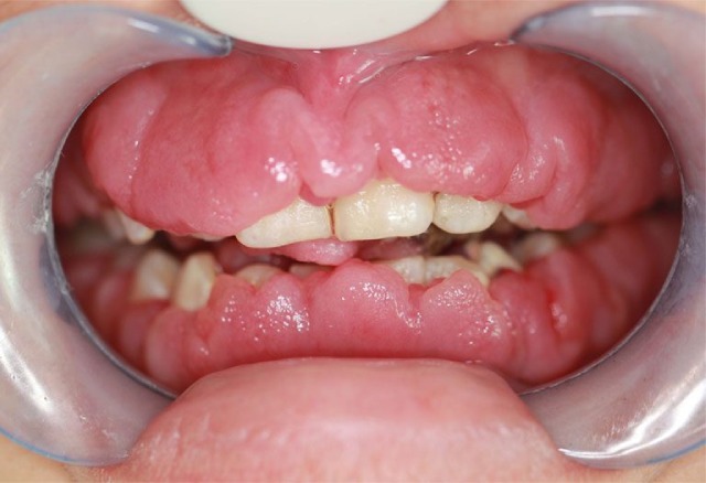 Những biến chứng của viêm lợi