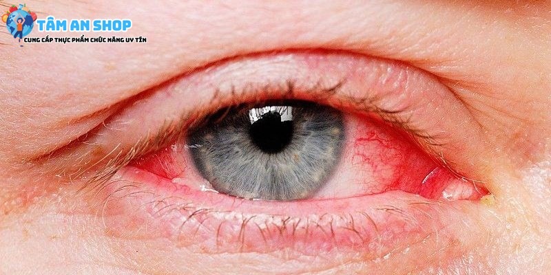 Viêm giác mạc gây nên mắt đỏ