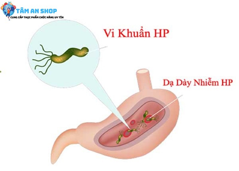 Nguyên nhân gây nhiễm khuẩn Hp dạ dày