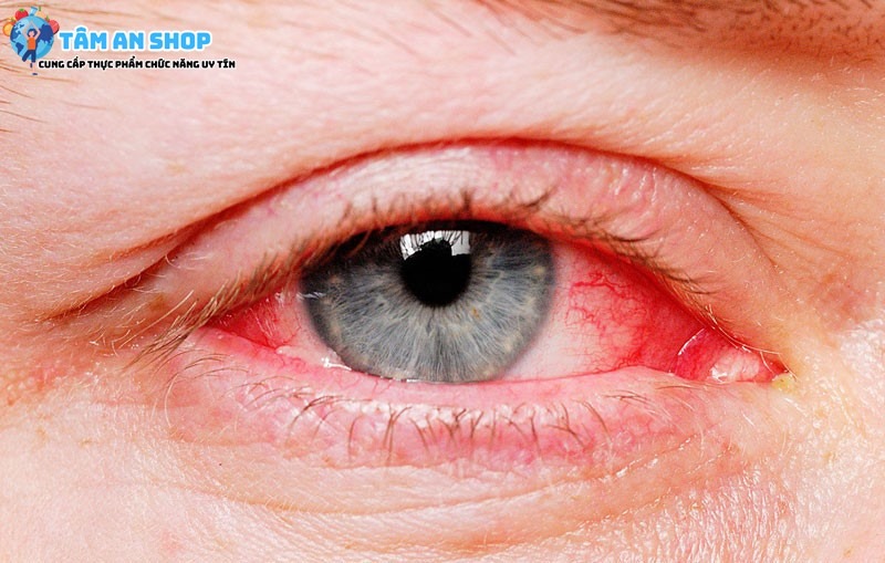 Nhiễm trùng mắt gây viêm giác mạc
