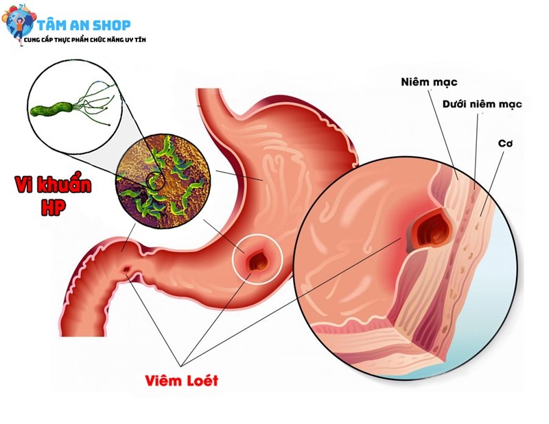 Nhiễm vi khuẩn Hp có tự hết không