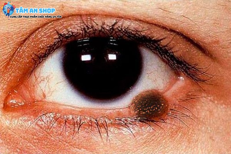 U hắc bào mắt