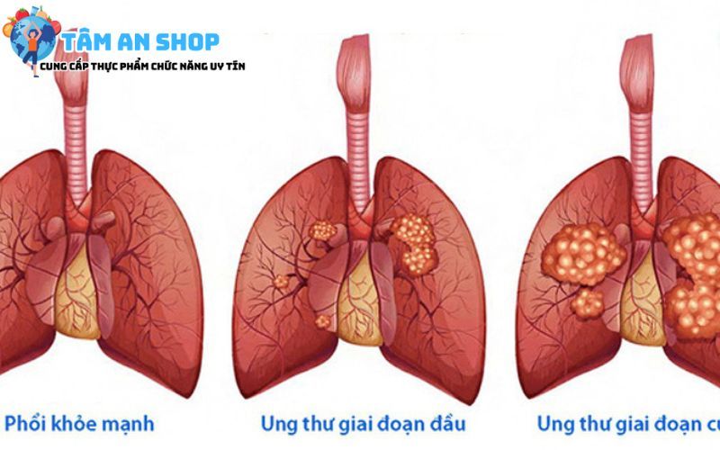 Ung thư phổi
